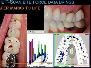 Dental Occlusion & Paper Marks with Dr. Robert Kerstein