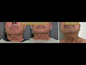 Nonsurgical treatment of turkey neck using PDO threads and Botox | Dr. Contessa Salvador