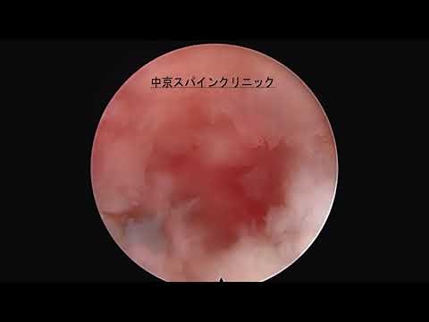 第４／５腰椎椎間板ヘルニア 内視鏡下椎間板摘出術（PELD/FELD TF法）Full endoscope Transforaminal approach