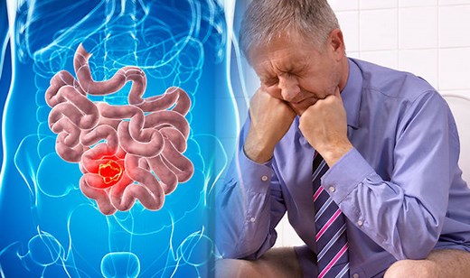 This Morning: Dr Chris explains symptoms of bowel cancer
