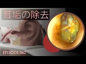062 - 死んだ感染した皮膚、耳のワックス、および液体がEardrumから除去された | 耳垢の除去 | Japan Earwax