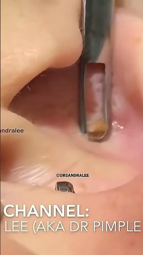 Watch This Giant Pimple Get Popped!
