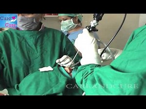 Live Sinus Surgery | Sinus Surgery | Endoscopic Sinus Surgery