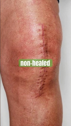 Stop! Before You Scrape That Post-Op Scar… Watch This