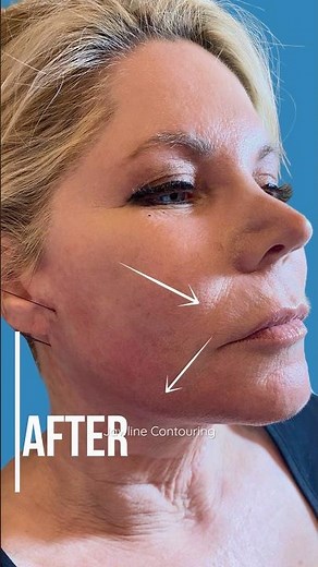 PDO Thread Lift Before and After, PCH MedSpa, Newport Beach