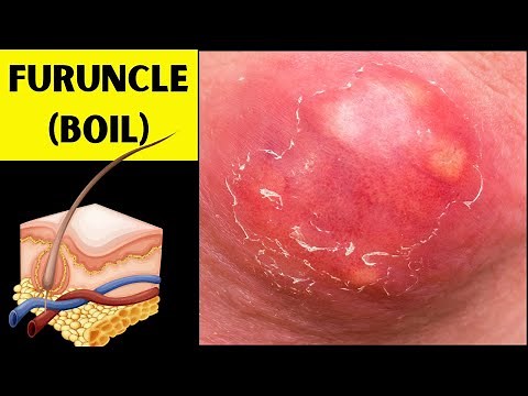 Boils (Furuncles) Unmasked - What You Need to Know |Causes, Signs & Symptoms, Treatment, Prevention