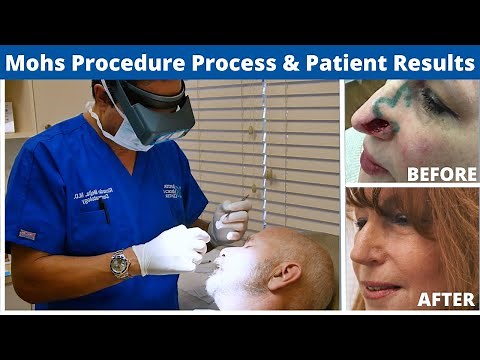 Mohs Surgery Procedure Explained From Start to Finish | Skin Cancer Treatment