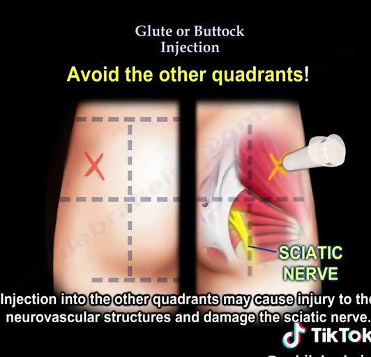 Safe Glute Injection Procedure: Tips for Avoiding Nerve Damage