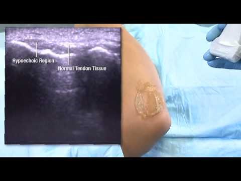 Ultrasound Diagnosis Lateral Epicondyle