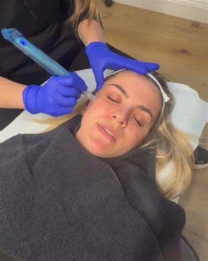 Nano Infusion Microneedling treatment