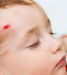 Concussion In Babies: Causes, Symptoms & 4 Prevention Tips