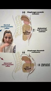 Bloating is caused by intestines protruding into the abdominal cavity. Functional reasons for a distended, abdomen tension, involve digestive problems that causes gas and or digestive contents to accumulate. Gas from the indigestion, food intolerances, or IBS originate here. This is perfect grounds to start constipation. #pelvicfloor #pelvichealth #pelvicfloorphysicaltherapy #pelvicfloorpt #pelvicfloorpta #pelvichealthnj #pelvichealthphysio #madisonnj #ibs #bloating #constipation #abdominaldiste