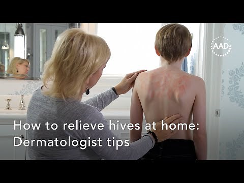 How to relieve hives at home
