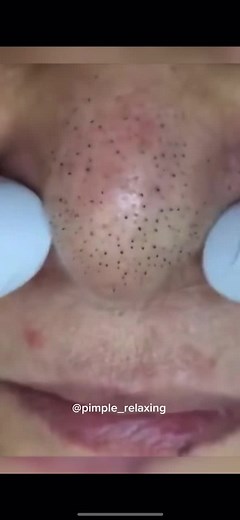 Super Gratifying Blackhead Extraction Satisfactory Video