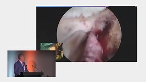Massive Subscapularis Tear: How to Release and to Repair