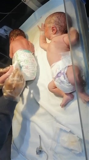 This video shows the proper care and assessment of premature twin babies. It includes checking vital signs, observing breathing, temperature maintenance, skin color, reflexes, feeding readiness, and overall health status. The video also covers kangaroo mother care (KMC), infection prevention, and safe handling of preterm newborns. Perfect for nursing students and caregivers to understand essential premature baby care. video is for educational purpose and not fir substitute #rdsbaby #newborn #Doc