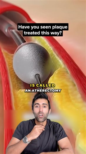 Kunal Sood, MD on Instagram: "An atherectomy is a procedure that removes hard, calcified plaque from inside an artery when balloon angioplasty or stenting alone isn’t enough. It helps restore blood flow and prepares the vessel for stent placement. Have you seen this procedure before? Follow @doctorsoood to improve your health IQ and for similar content. VC: @health.hub512 #atherectomy #cardiology #medical"