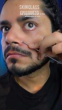 Whitehead Removal at Home – Safe & Easy Method | Skin Class Ep. 13 #skincareroutine