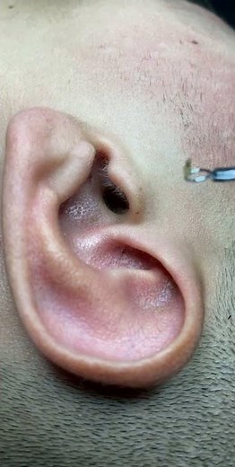 Blackheads 2021 newest dr pimple popping videos Ep 186