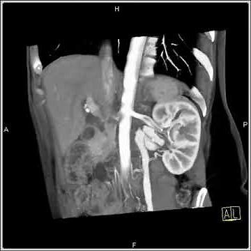 Abdomen: Stomach: SMA Syndrome: Vascular mapping(6 of 7)