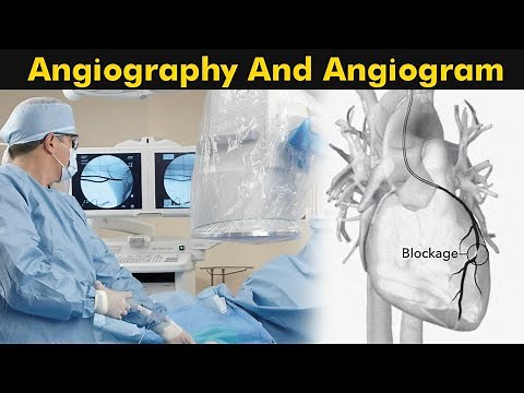 What is Angiography and Angiogram? | How Angiography is performed? (3D Animation)