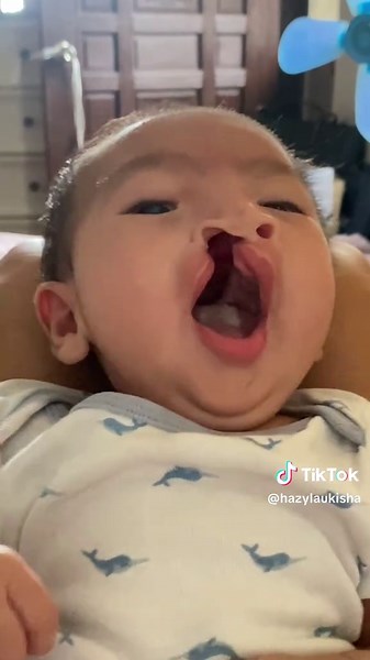 Cleft Warrior: Inspirasyon at Pag-asa