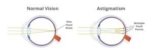 Vivity™ Lens: Cataract & Astigmatism Correction