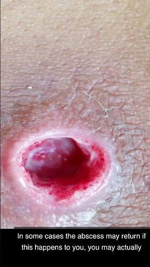 HUGE Painful Boil ! Needs to pop | How to Treat A Boil after Popping