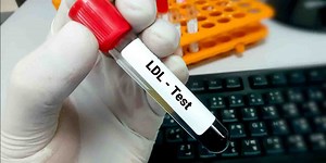 Lipoprotein (a) Blood Test what is it used for, normal range, and more