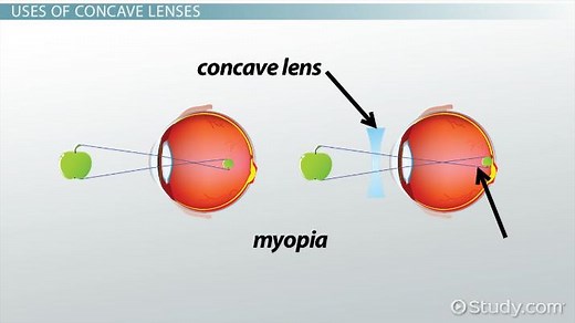 Concave Lens | Definition, Uses & Examples