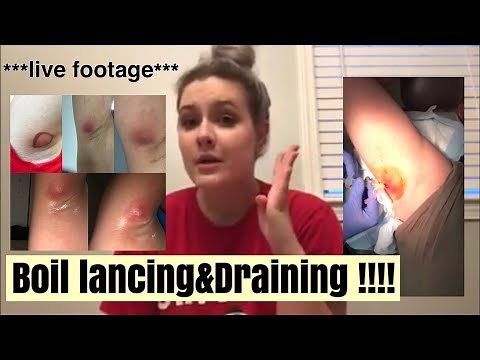 BOIL LANCING & DRAINING ***LIVE FOOTAGE*** | KELLEY THURLOW
