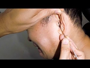 Removing Man's Massive Earwax | Hearing Loss No More