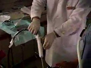 Endometrial Ablation without Anesthesia by Promedical Inc.