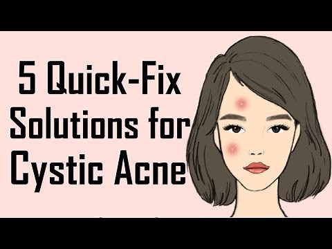 5 Remedies to get rid of Cystic Acne | How to get rid of Cystic Acne