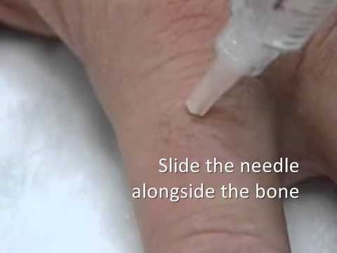 Digital Nerve Block Technique