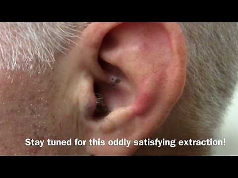Ear Blackhead Extraction | Dr Steven Greene in Seattle