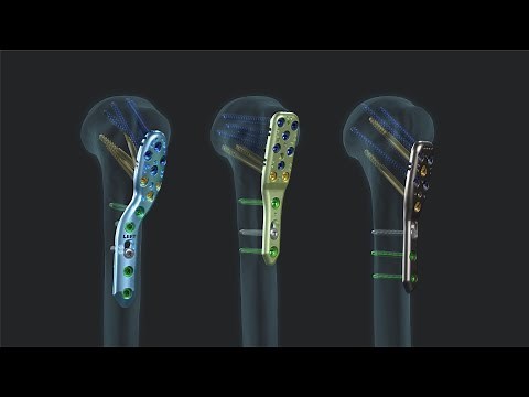 Proximal Humerus Plating System
