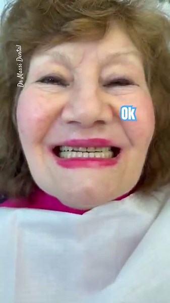 Flexible Upper Partial Denture