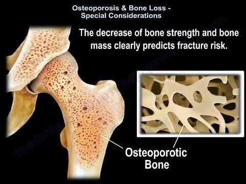 understanding Osteoporosis - Everything You Need To Know - Dr. Nabil Ebraheim