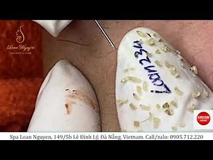 Blackheads extraction (234) | Loan Nguyen