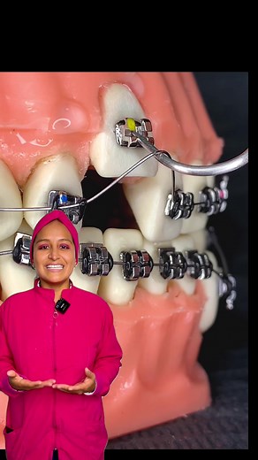 Brackets y Alineadores on TikTok