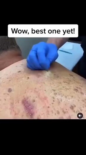 Blackheads Popping & Blackhead Removal Videos 2022