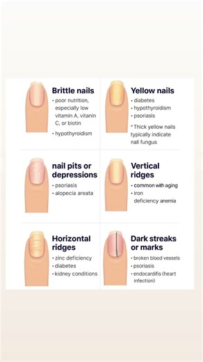 What Your Nails Reveal About Your Health: 6 Signs You Shouldn’t Ignore #shorts