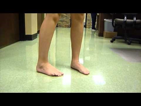 Lorelei before and after flat foot reconstruction