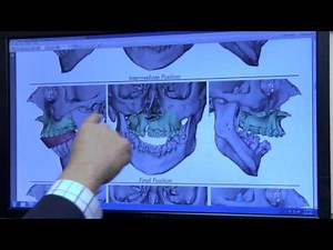 Virtual Surgery Planning