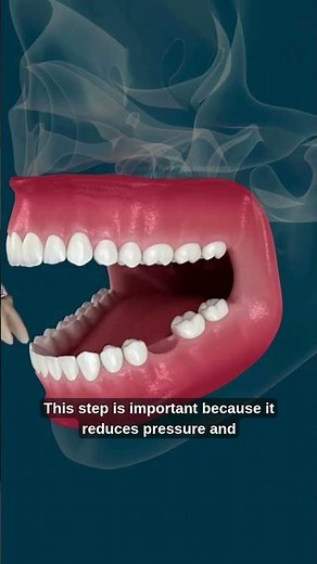 What Really Happens During a Tooth Extraction Dental Procedure Explained in 30 Seconds”