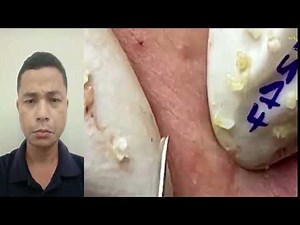 Extreme Acne & Pimple Popping Compilation – Blackhead & Cyst Removal