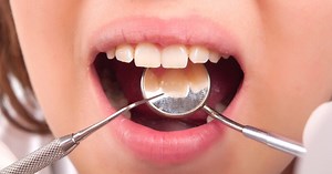 What is Plaque vs Tartar & How to Remove Plaque from Teeth