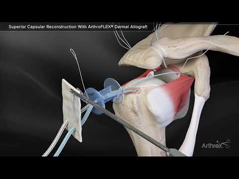 Superior Capsular Reconstruction