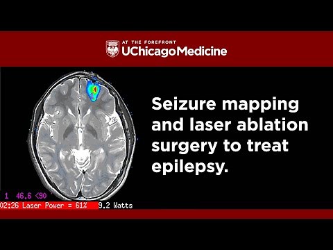Stopping Seizures: Seizure Mapping and Laser Ablation Surgery for Epilepsy